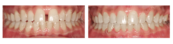 Before and after photos Marshall Orthodontics in La Mesa, CA