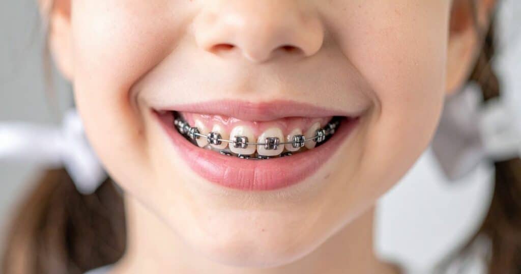 A child smiling with silver braces.