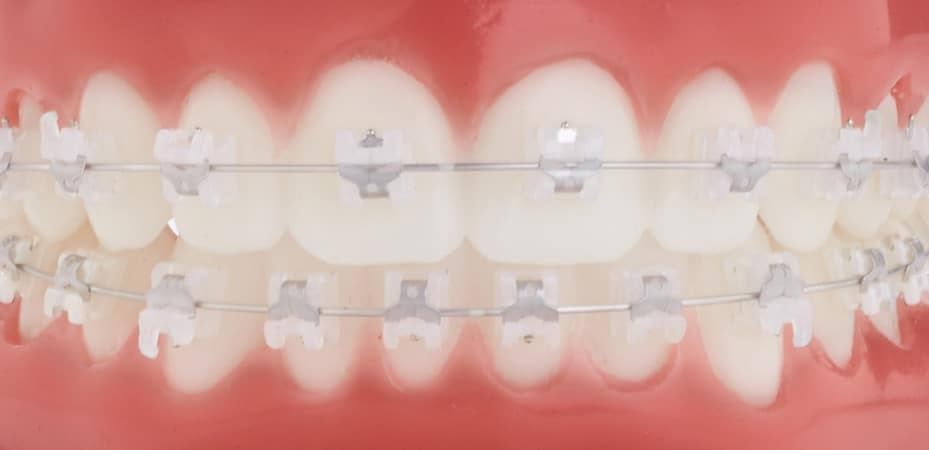 GC-ceramic-experience-braces-on-teeth